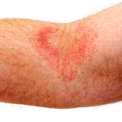 Example of eczema